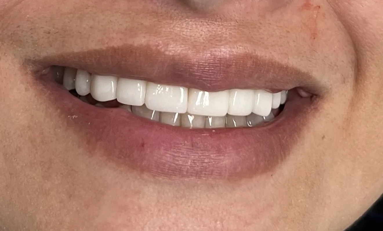 Crowns, Veneers and Implants at Berger Dental in Denton, TX — before treatment