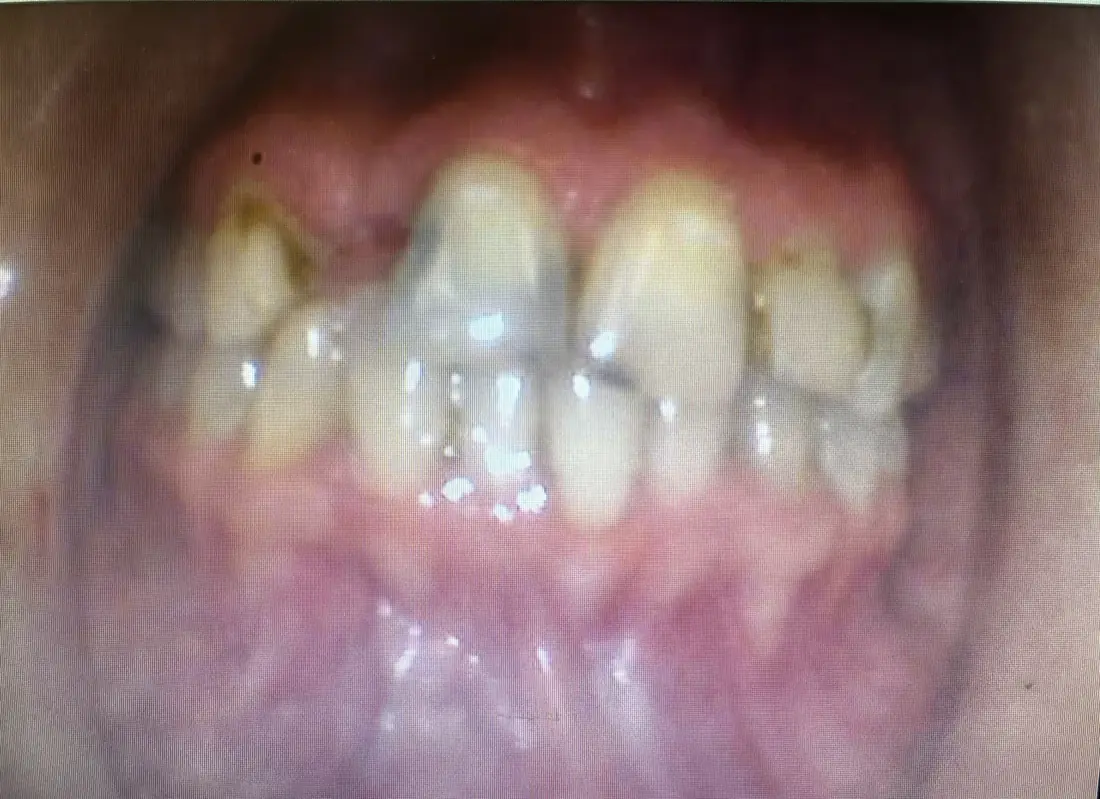 Crowns, Veneers and Implants at Berger Dental in Denton, TX — after treatment