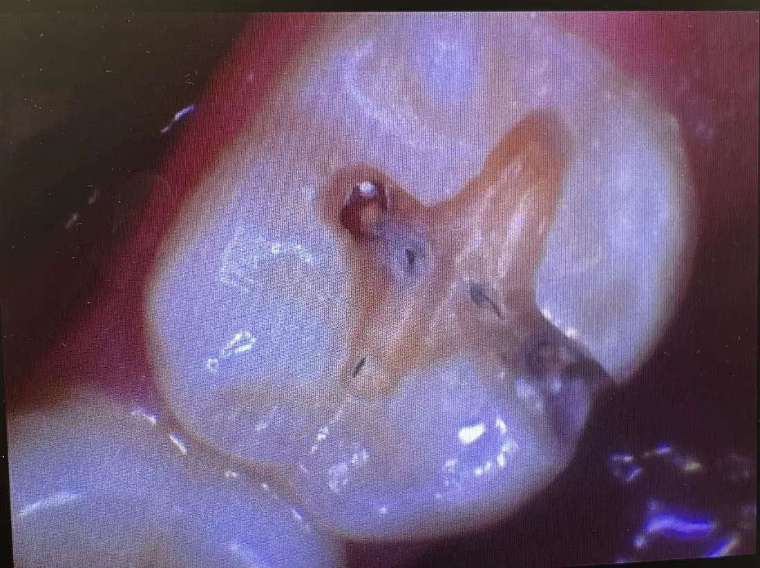 Fillings and Cavity Treatment at Berger Dental in Denton, TX — after treatment