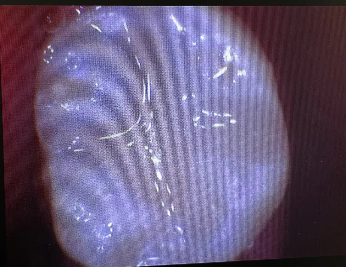 Fillings and Cavity Treatment at Berger Dental in Denton, TX — before treatment